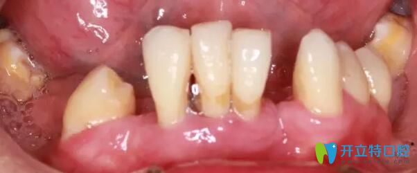 南通摩爾口腔牙齒種植前