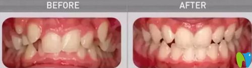 使用兒童MRC治療前后的效果圖