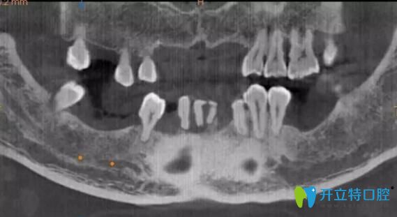 牙齒缺失怎么辦？看看南通摩爾口腔數(shù)字化種植牙你就知道