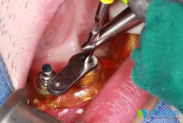 南通摩爾口腔種植牙5顆