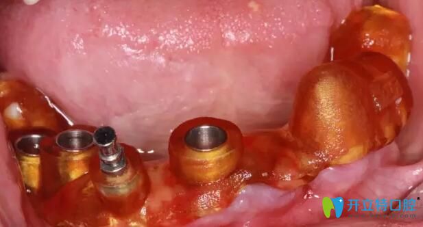 南通摩爾口腔牙齒種植