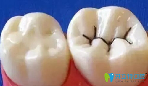 窩溝封閉對比圖