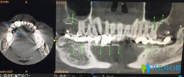 南通摩爾口腔術(shù)前手術(shù)設(shè)計(jì)