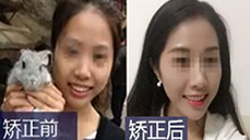 無(wú)錫拜博口腔陳炳霖給我做了牙齒矯正 我覺(jué)得臉型變了