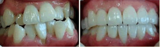 杭州美奧口腔三個月前 牙齒擁擠的我找杭州美奧王明做了隱形牙齒矯正