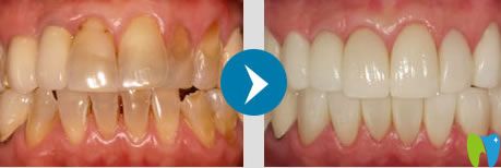 南京雅康張文震美容冠案例