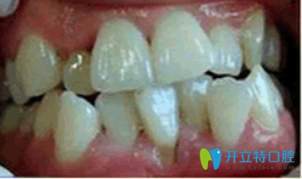 杭州美奧口腔牙齒矯正前的我