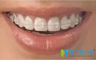 南京雅康半隱形陶瓷矯正