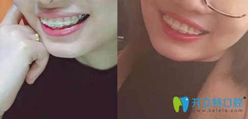 陳炳霖做牙齒矯正后兩個月的照片