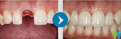 南京雅康簡海茲院長種植牙案例 南京雅康簡海茲院長種植牙案例