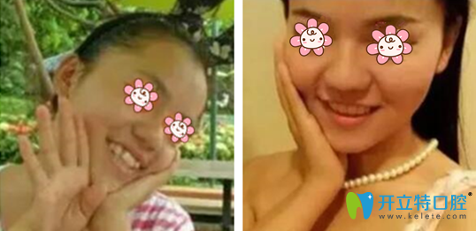 牙齒矯正的好處有哪些，一般矯正牙齒多少錢？