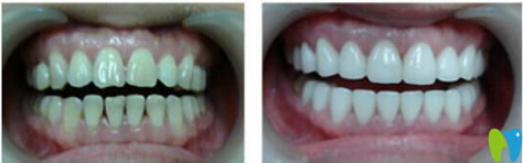 廣州圣貝口腔烤瓷牙種植案例對比圖 廣州圣貝口腔烤瓷牙種植案例對比圖