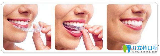 隱形矯正是如何進行的? 隱形矯正是如何進行的?