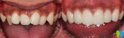 廣州圣貝口腔隱形牙齒矯正案例 廣州圣貝口腔隱形牙齒矯正案例