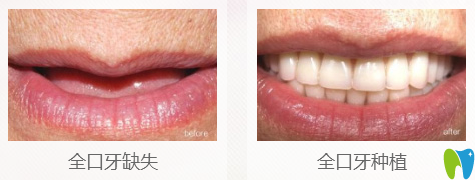 吳豪陽(yáng)全口牙種植案例對(duì)比效果