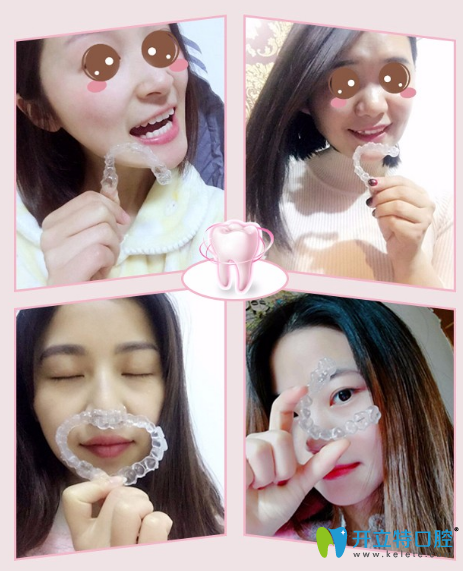 廣州圣貝口腔時代天使隱形矯正案例 廣州圣貝口腔時代天使隱形矯正案例