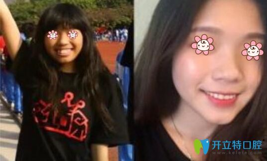趙越主任牙齒矯正案例 趙越主任牙齒矯正案例