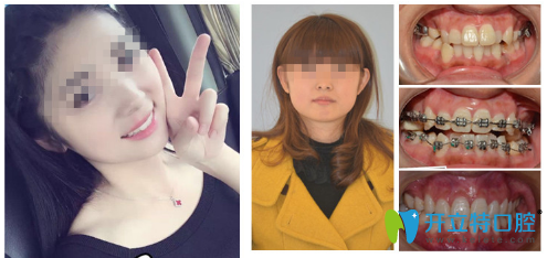 廣州圣貝口腔3M金屬托槽牙齒矯正案例 廣州圣貝口腔3M金屬托槽牙齒矯正案例