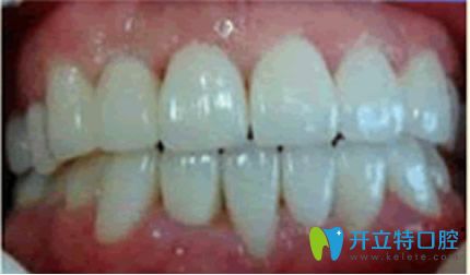 杭州美奧牙齒矯正三個月效果案例