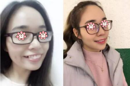 牙齒矯正后悔一輩子真相揭秘，那為什么有人30歲還矯正牙齒