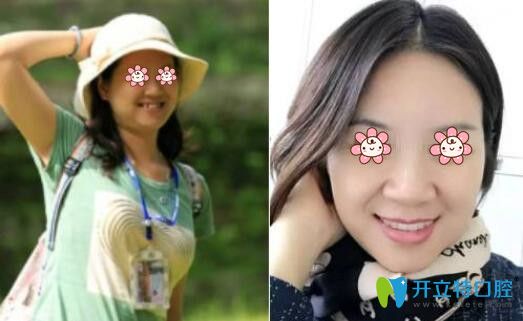 劉曉丹院長(zhǎng)種植牙齒案例