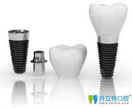 ITI種植是應(yīng)用較廣泛的種植系統(tǒng) ITI種植是應(yīng)用較廣泛的種植系統(tǒng)