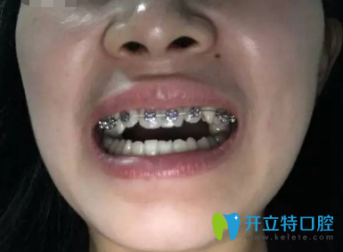 大家看看我去西安蓮湖圣貝口腔門診部做的地包天牙齒矯正