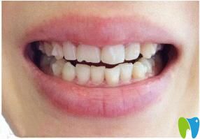 隱形牙齒矯正三個(gè)月效果