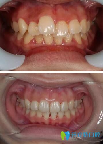段嬌紅牙齒矯正案例