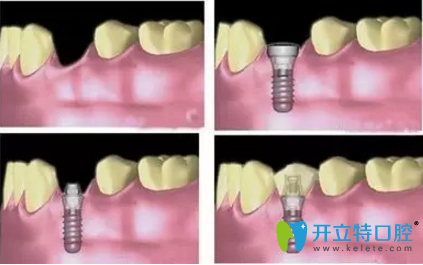 ITI種植材料采用四級(jí)純鈦材料 ITI種植材料采用四級(jí)純鈦材料