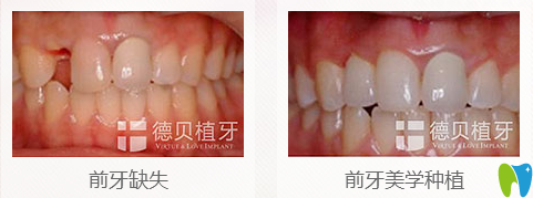 牙缺失種植牙前后對比效果