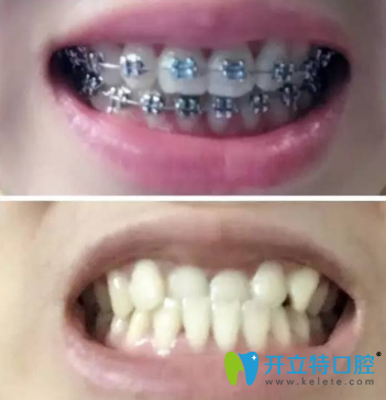 剛帶上牙套的樣子 剛帶上牙套的樣子