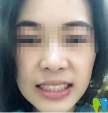 牙齒完全恢復(fù)好的樣子 牙齒完全恢復(fù)好的樣子