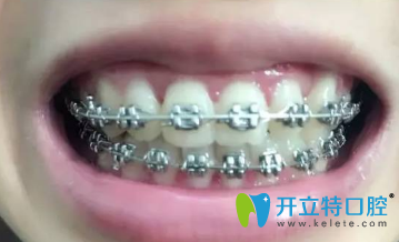 一個(gè)月后牙齒樣子