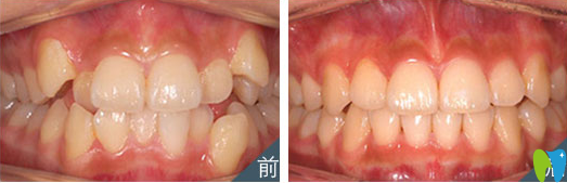 牙齒不齊矯正前后 牙齒不齊矯正前后