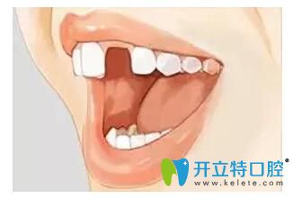 如果缺少了一顆牙 是選擇種植牙好還是烤瓷牙好呢？