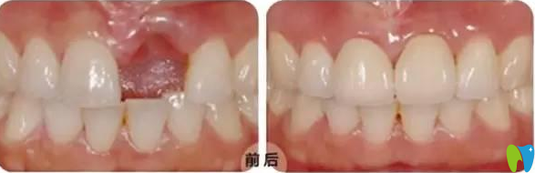 種植牙前后 種植牙前后