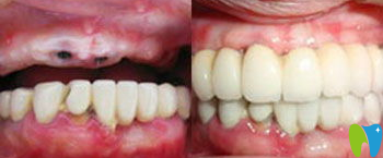 寧波牙博士口腔金勇和醫(yī)生種植牙效果對(duì)比圖