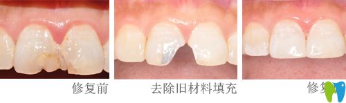 楊瑾瑛醫(yī)生做牙齒修復(fù)案例 楊瑾瑛醫(yī)生做牙齒修復(fù)案例