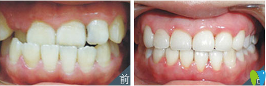地包天矯正前后 地包天矯正前后