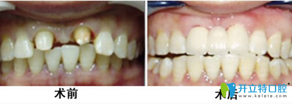 唐琛琛醫(yī)生牙齒種植修復真人案例 唐琛琛醫(yī)生牙齒種植修復真人案例