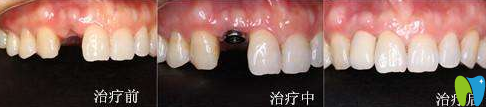 寧波牙博士口腔孔華鋒種植牙效果對比圖