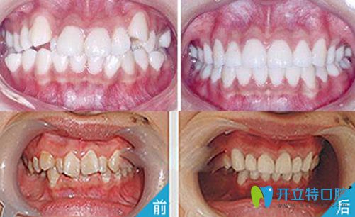 重慶牙博士口腔劉永貴院長牙齒矯正案例對比圖