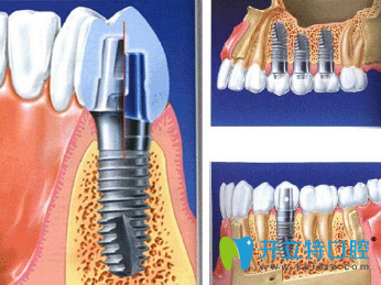 種植牙優(yōu)勢(shì)