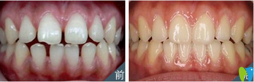 牙齒稀疏矯正前后