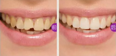 門牙缺損怎么辦？看湛江珠江口腔做嵌體修復(fù)后真假牙難辨