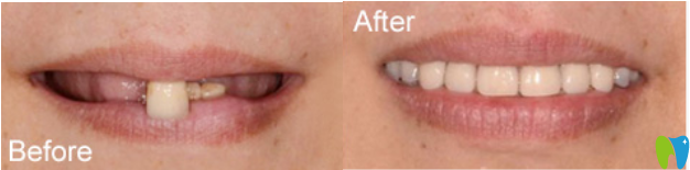 洛陽牙齒矯正案例效果