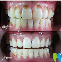 廣州暨博口腔黃曉雁前牙齲齒修補案例圖