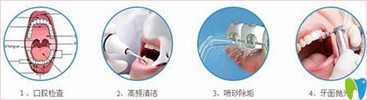揚(yáng)洲菲特口腔超聲波潔牙過程 揚(yáng)洲菲特口腔超聲波潔牙過程