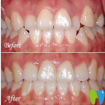 廣州暨博口腔楊翔寬牙齒正畸案例對比圖